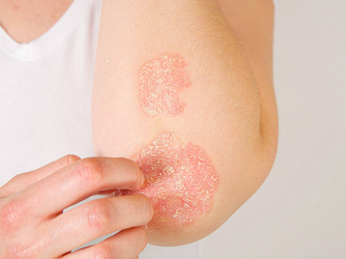 230403 Wdg Psoriasis 1