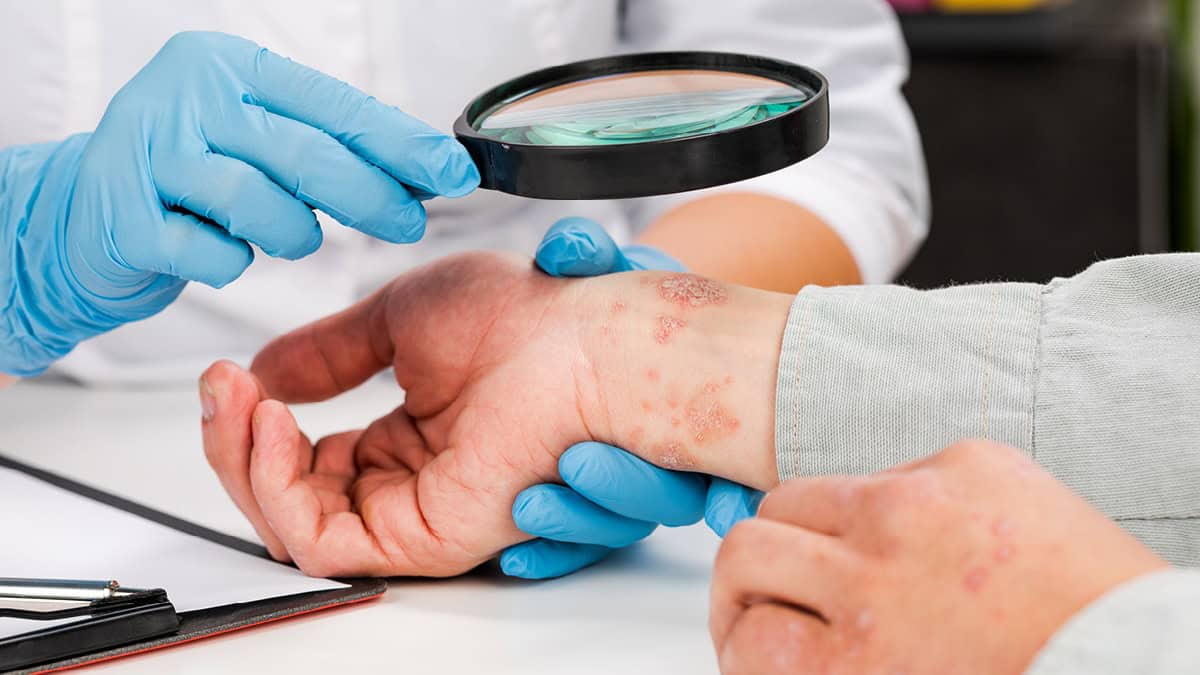 230403 Wdg Psoriasis 8